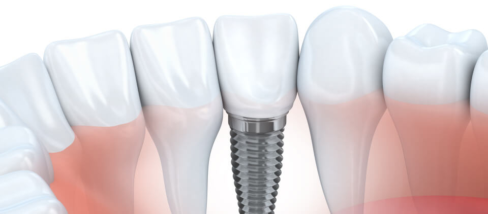 Dental Implants | Bryn Mawr Implant Dentistry | Wayne Implant Dentistry | Dr. Amy Shoumer